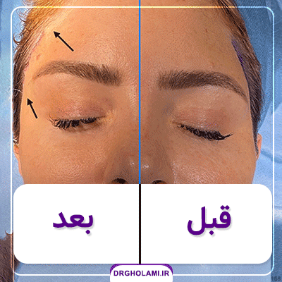 لیفت ابرو